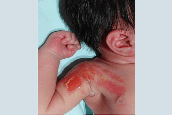 IMSS de Aguascalientes quema a recién nacido con una jeringa
