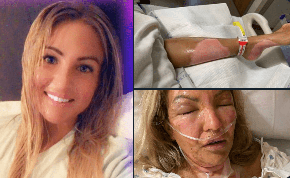 Mujer de Texas termina con graves quemaduras por encender una vela tras usar gel desinfectante para manos