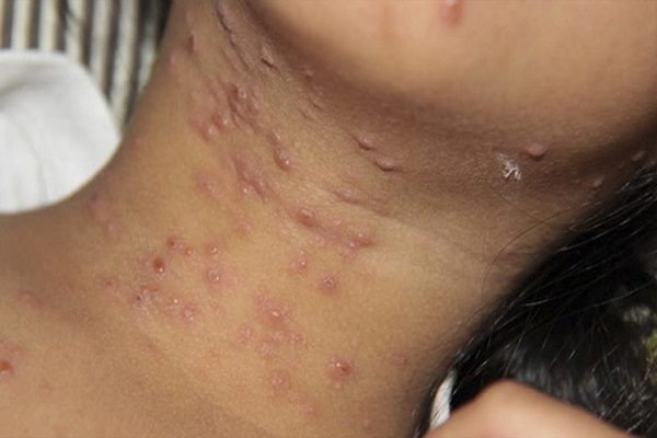 Autoridades en alerta ante casos de lepra en Yucatán y Quintana Roo