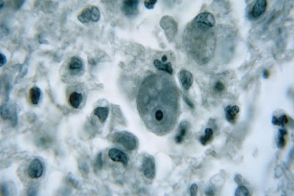 Alertan migración de ameba ‘comecerebros’ hacia el norte de EU