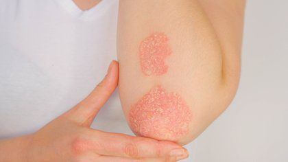 Psoriasis, la enfermedad crónica, pero poco conocida