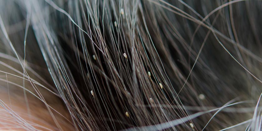 Disminuye venta de productos para piojos, ante aislamiento