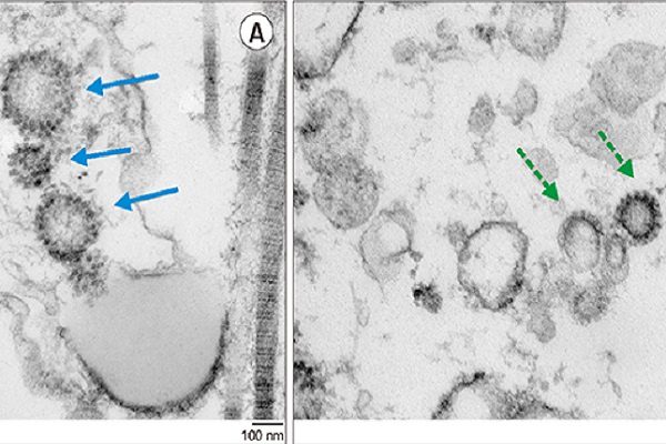 Covid-19 puede invadir los testículos y causar infertilidad, revela estudio