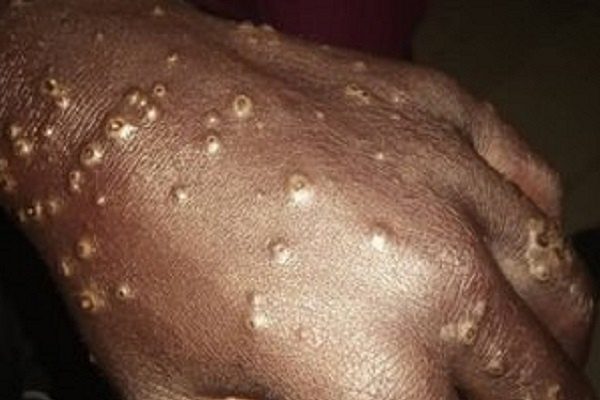 500 personas se contagiaron de una rara enfermedad tras entrar al mar