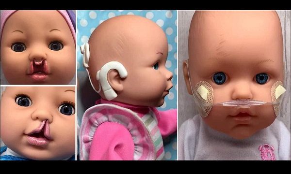 Con labio leporino, aparatos para sordera y hemangiomas, bebés inclusivos rompen esquemas