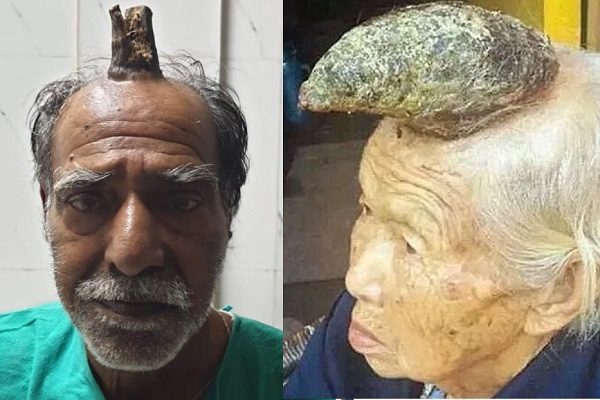 Cuernos cutáneos, los tumores de aspecto "siniestro"