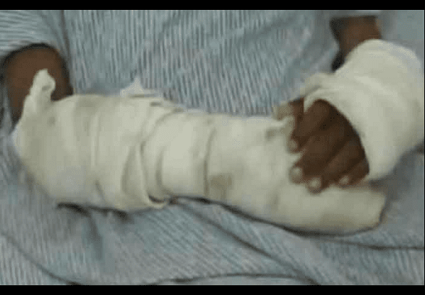 Por robar dulces, madre quema los brazos de su hija de 6 años