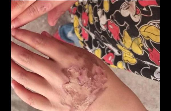 Mamá permite que su novio queme a su hijo para "castigarlo"