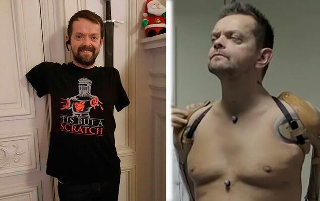 Se convierte en la primer persona en recibir trasplante de brazos #VIDEO