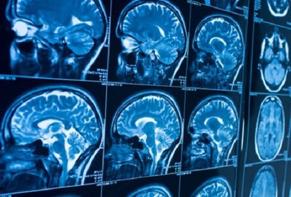 Estudio revela que coronavirus se esconde en el cerebro y causa grandes daños