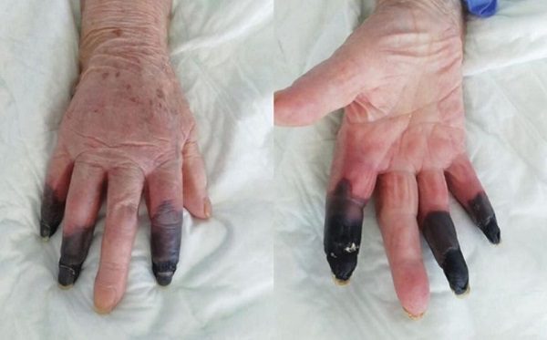 Mujer sufre amputación de sus dedos por rara secuela de Covid
