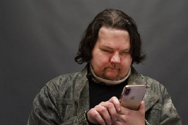 Joven de 22 años recibe trasplante exitoso de cara y manos