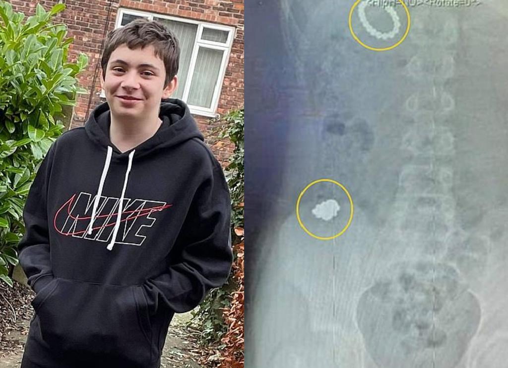 Niño con autismo se come imanes para volverse “magnético”