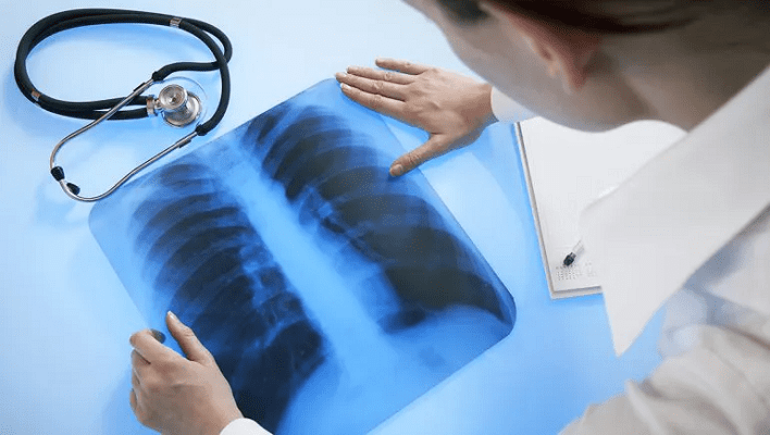 Mujer diagnosticada con Tuberculosis tenía un condón en su pulmón