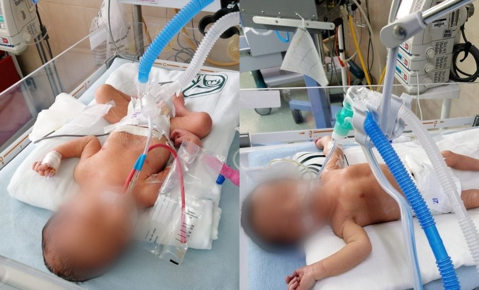 IMSS atiende a dos bebés con órganos expuestos en Chihuahua