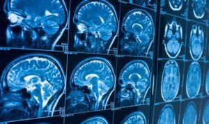 Según estudio, síntomas neurológicos de covid-19 aumentan 6 veces las posibilidades de morir