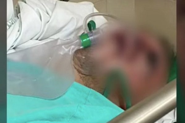 Fallece Gregorio Avendaño, paciente que presuntamente padecía 'hongo negro'