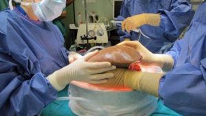 Pacientes del IMSS reciben exitoso trasplante de hígado