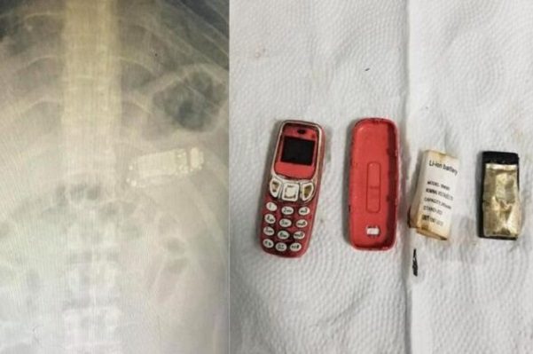 Cirujano extrajo un celular Nokia completo del estómago de un preso, en Kosovo