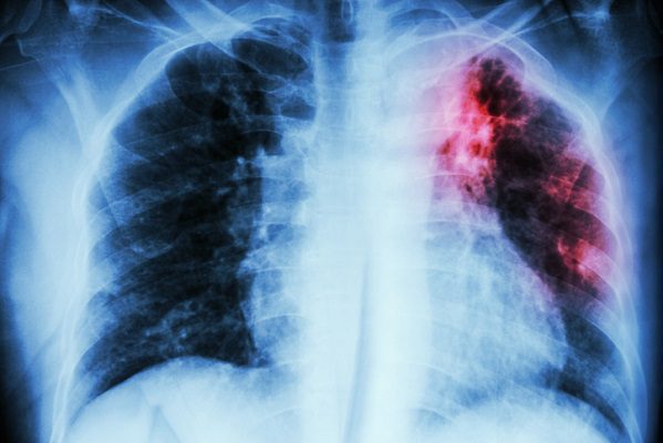 Debido a la pandemia, aumentaron muertes por tuberculosis, advierte la OMS