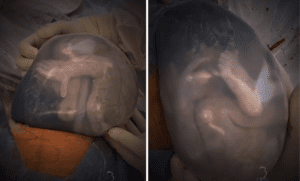 #VIDEO de bebé dentro de bolsa amniótica se hace viral