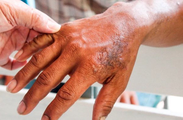 La lepra avanza en 21 entidades de México; 5 estados concentran 60% de los casos