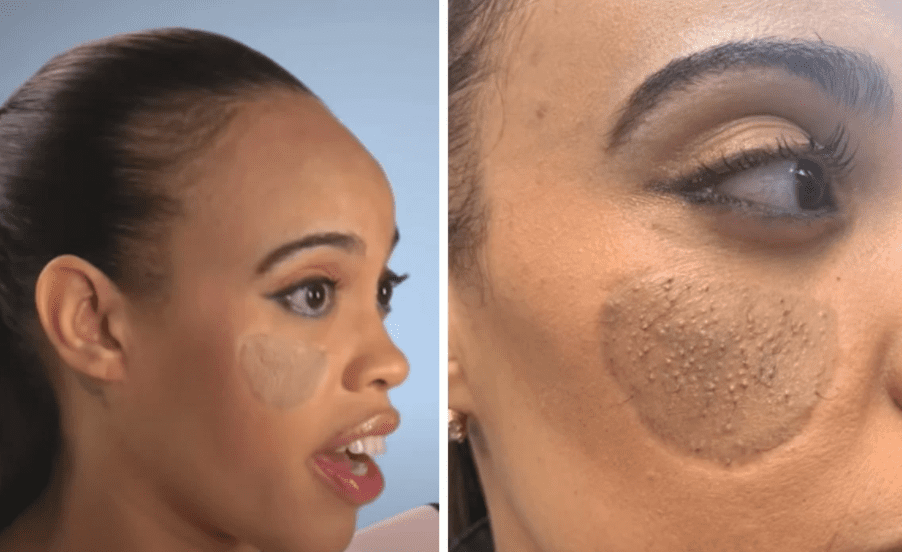 Le injertan piel de la ingle en su cara y le salió vello púbico