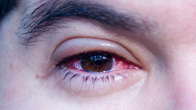 Conjuntivitis, síntoma que indica que contrajiste COVID