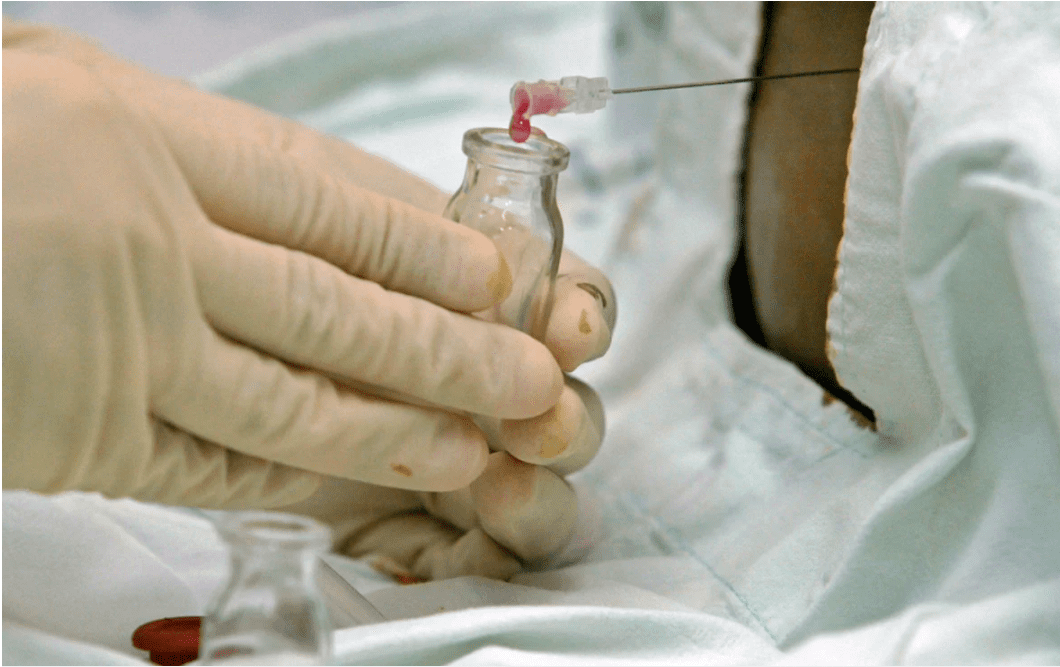 Por medio de sangre de cordón umbilical curan a paciente con VIH