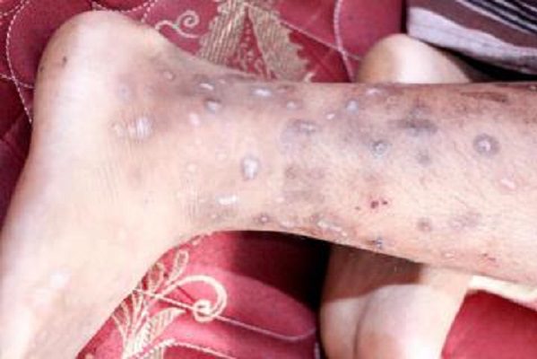 Alertan sobre una enfermedad cutánea altamente contagiosa en Haití