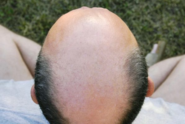 Tribunal en Reino Unido dictamina acoso sexual a un hombre por ser llamado "calvo"