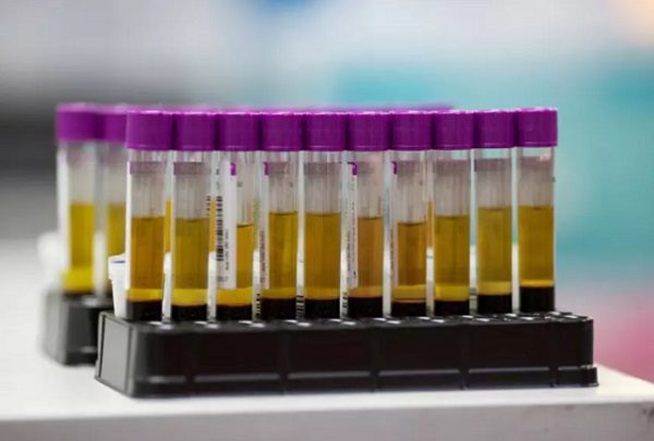 Científicos de Brasil desarrollan prueba de orina para detectar COVID-19