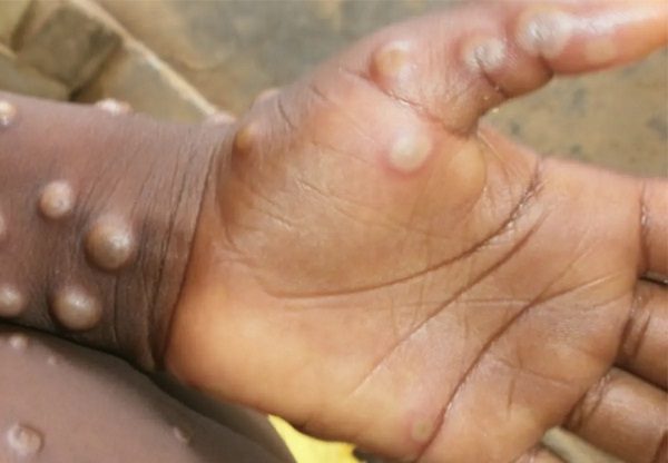 Inglaterra reporta siete casos de viruela del mono