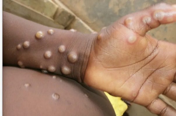 Cinco casos de viruela del mono en Portugal y ocho sospechosos en España