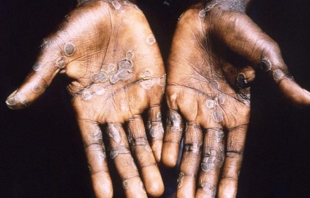 Detectan primer caso sospechoso de viruela del mono en Argentina