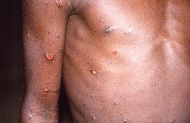 Vacuna contra la viruela del mono previene un 85% la viruela símica: OMS