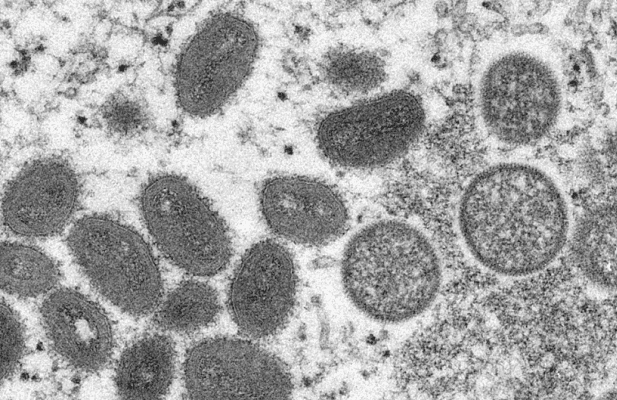 Alemania establece 21 días de aislamiento ante contagios de viruela del mono