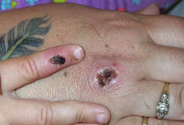 La OMS asegura que la viruela del mono es controlable en el Oriente Medio