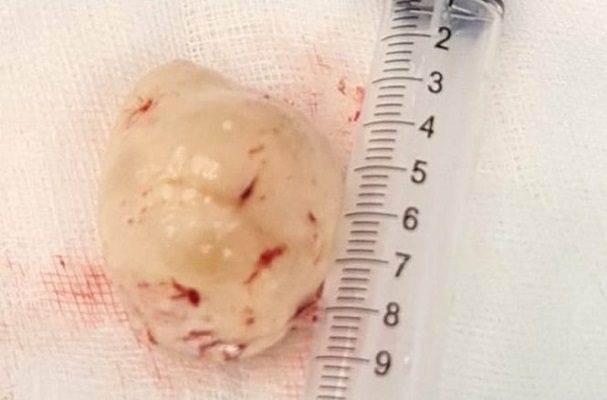 Médicos del ISSSTE retiran un tumor cerebral maligno del tamaño de un huevo