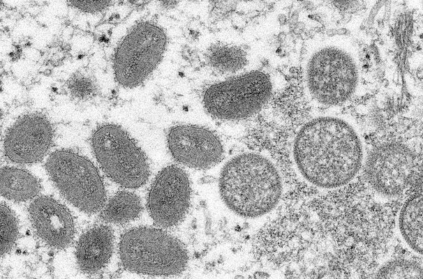 Ya suman 100 casos de viruela del mono en Portugal