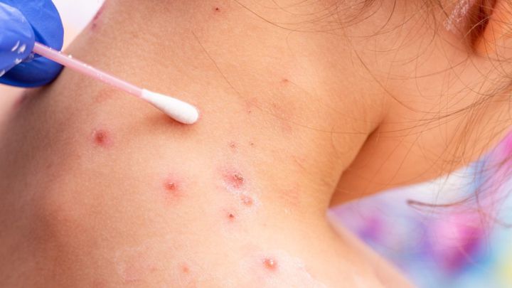 Casos de viruela del mono