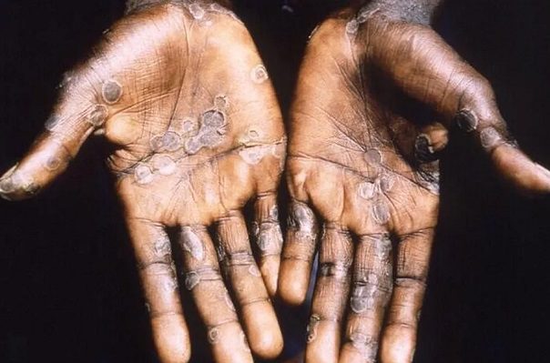 La OMS confirma 643 casos de viruela del mono a nivel mundial; Francia reporta 33 casos