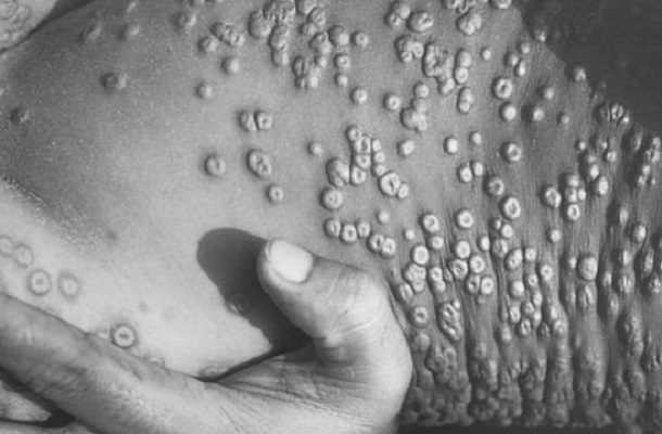 Analizan caso sospechoso de viruela del mono en Baja California