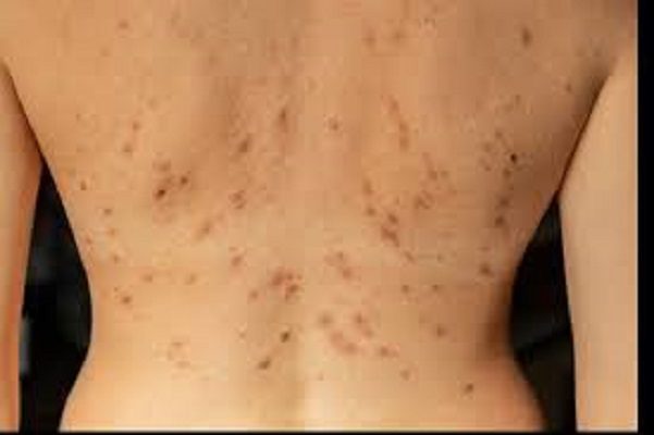 Reportan caso sospechoso de viruela del mono en Nuevo Laredo, Tamaulipas