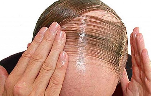 ¿Un milagro? EE.UU. aprueba primera píldora para el tratamiento de la alopecia