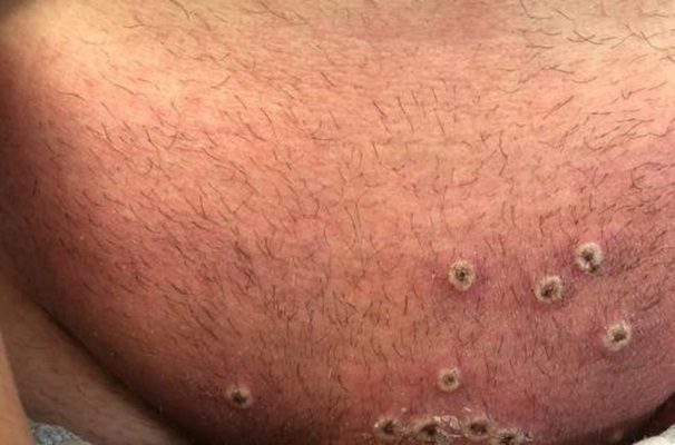 Secretaria de Salud de CDMX reporta cuatro casos de viruela del mono