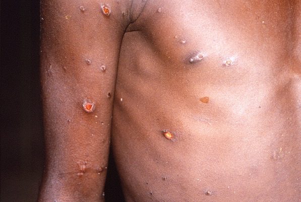 La Unión Europea comprará de más de 100 mil vacunas contra la viruela del mono