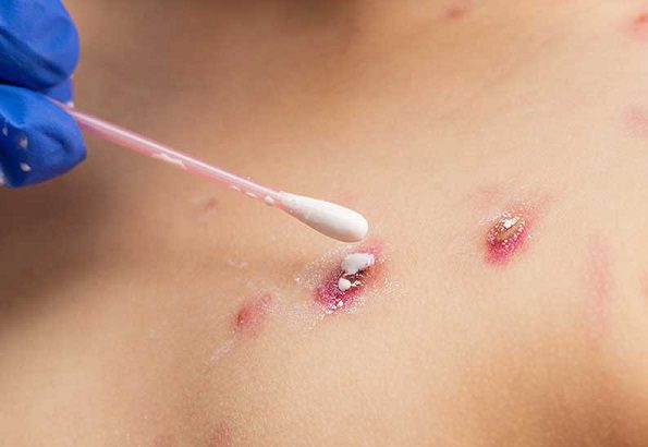 OMS convoca comisión para evaluar peligrosidad de viruela del mono