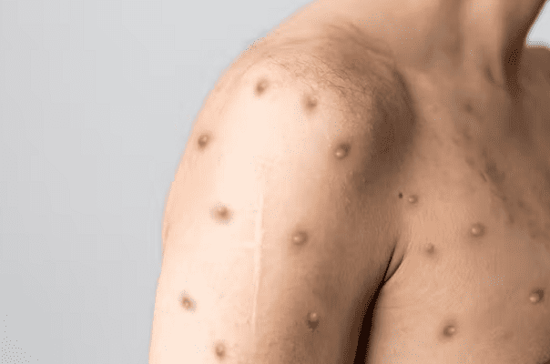 La transmisión aérea de la viruela del mono no ha sido reportada, aseguran los CDC