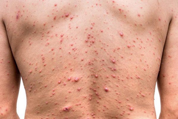 Viruela del mono debe combatirse sin repetir errores de la pandemia, advierte la OMS